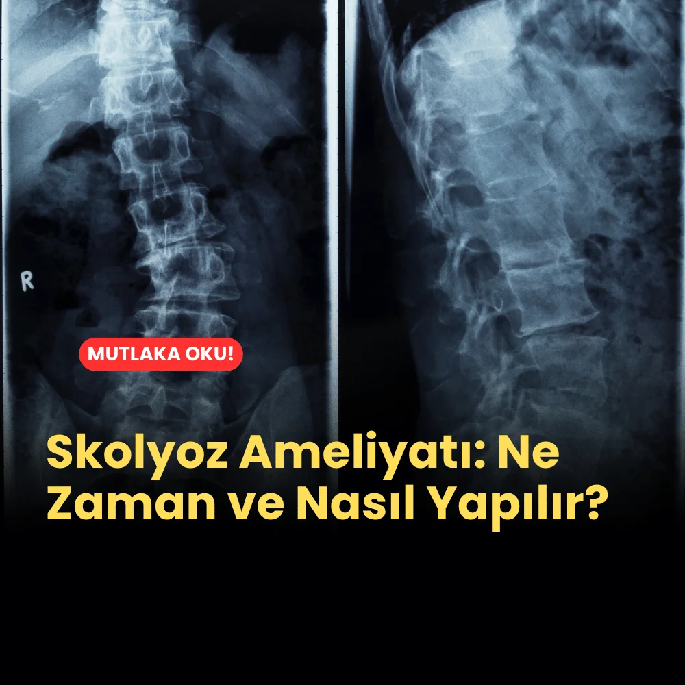 skolyoz ameliyatı, ne zaman ve nasıl yapılır?
