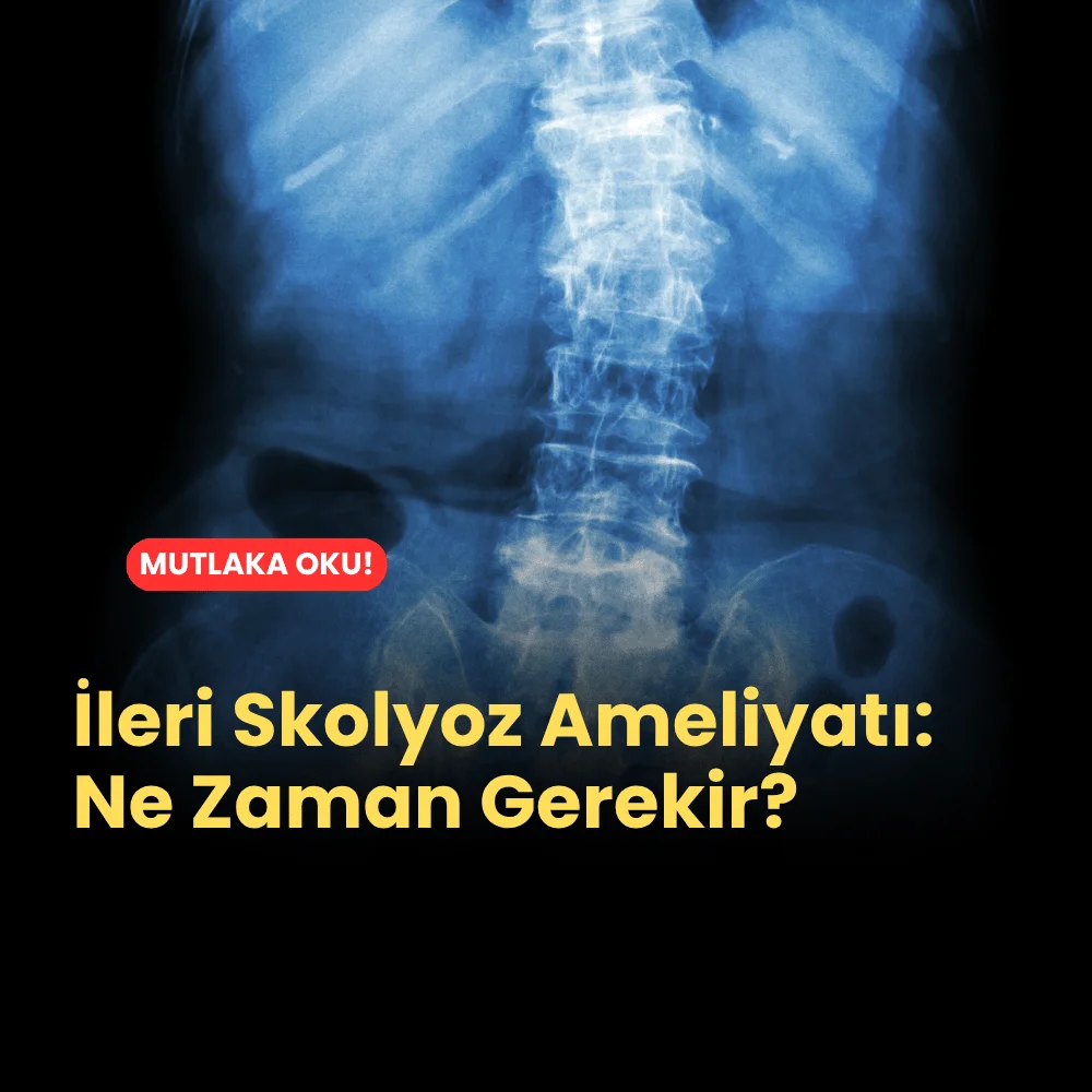 İleri Skolyoz Ameliyatı: Ne Zaman Gerekir? 1 İleri Skolyoz Ameliyatı Ne Zaman Gerekir