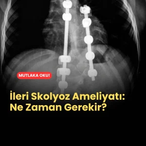 İleri Skolyoz Ameliyatı Ne Zaman Gerekir?