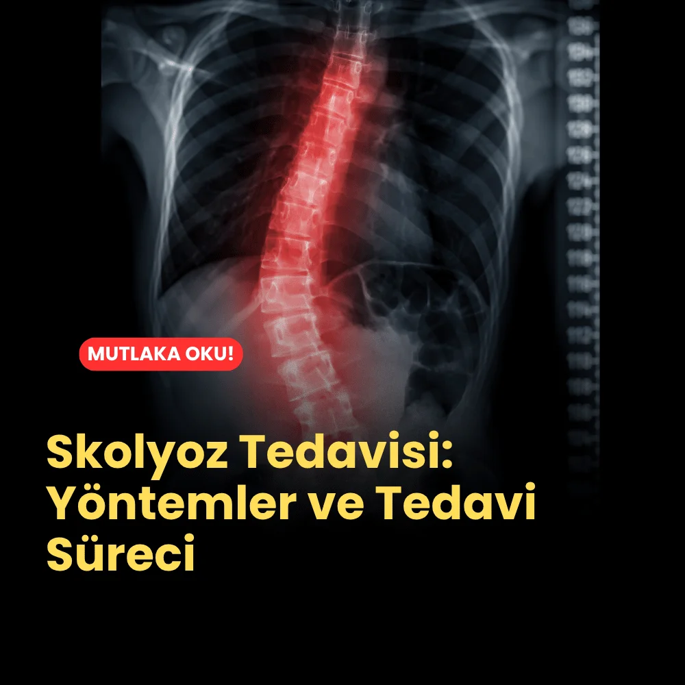 Skolyoz Tedavisi: Yöntemler ve Tedavi Süreci 1 Skolyoz Tedavisi Yöntemler ve Tedavi Süreci